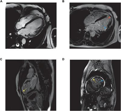 Case report: Heart failure secondary to myocardial infarction in a fertile woman with woven coronary artery